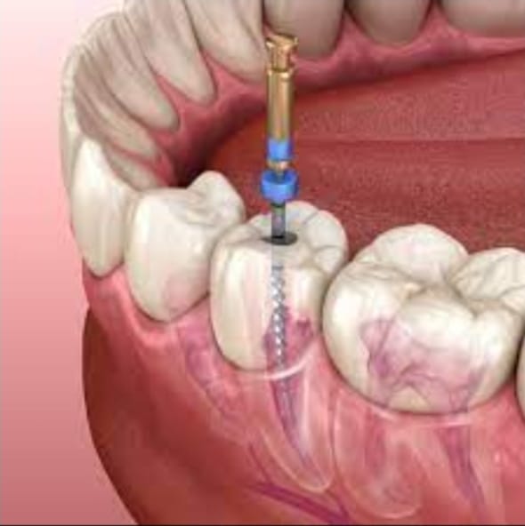 Zahnerhalt: Wurzelbehandlung mit endodontischer Feile
